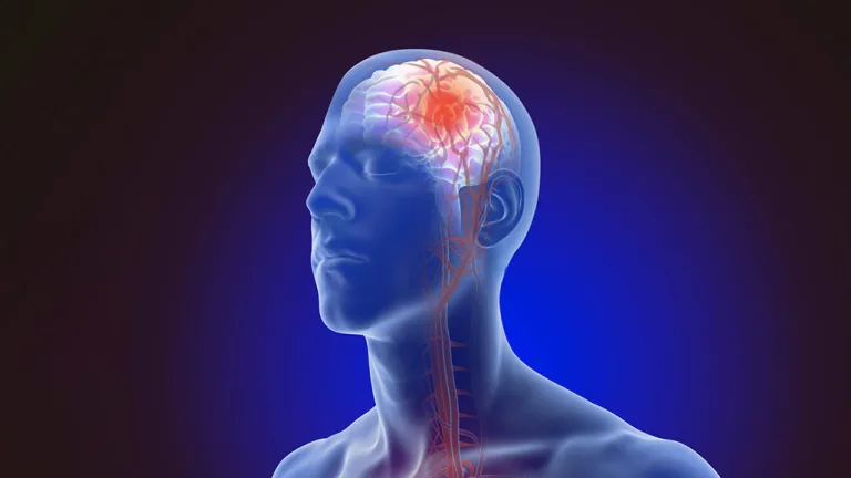 ما هي أعراض وعلامات السكتة الدماغية؟